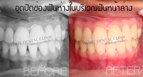 Dental Cosmetic
